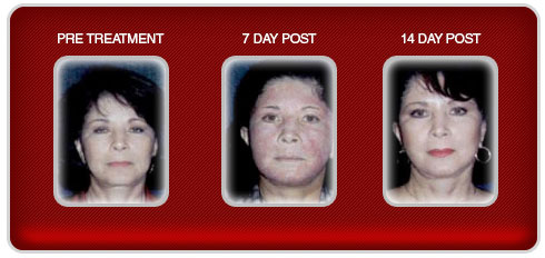 laser-resurfacing